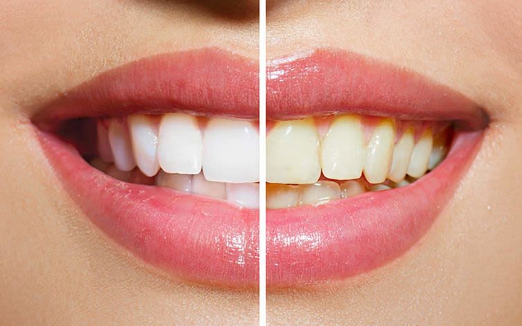 A satisfied patient with a radiant, white smile, symbolizing the confidence boost from effective teeth whitening Huddersfield