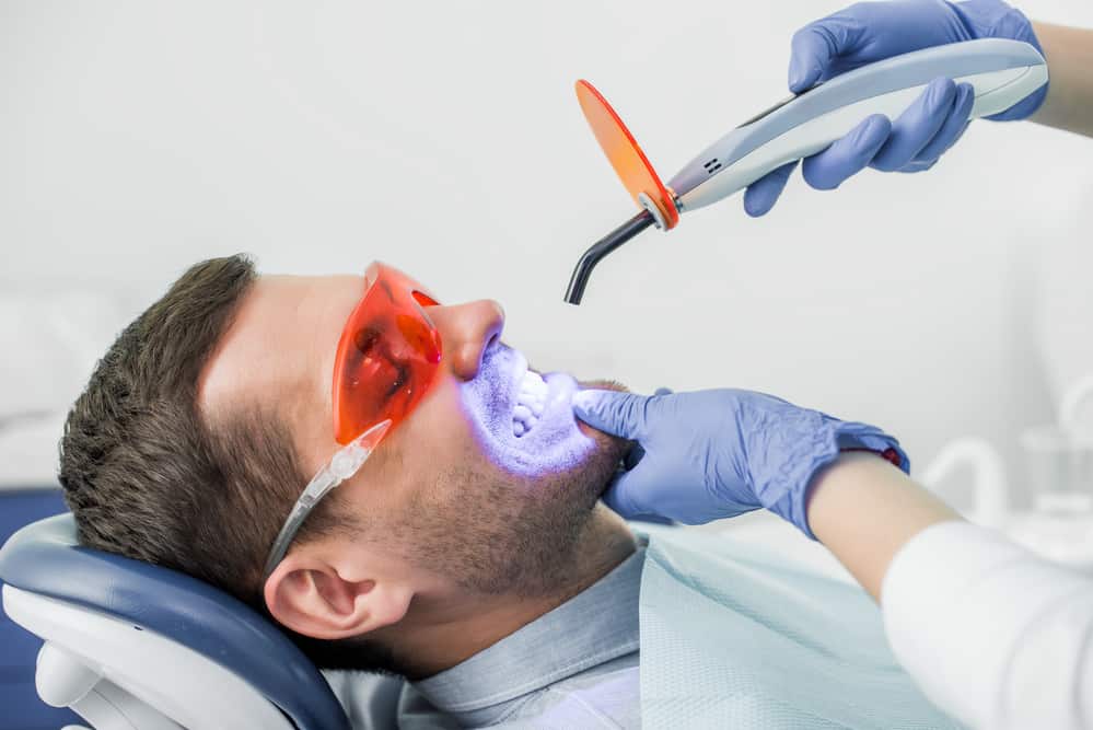 Why Laser Teeth Whitening is the Top Choice for Smokers Huddersfield
