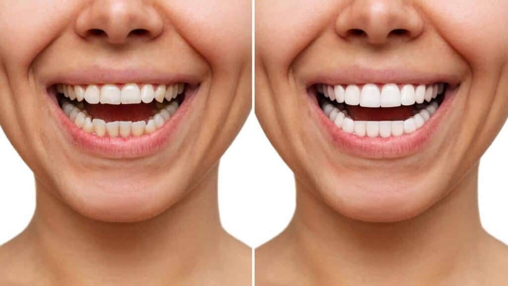 Contact Aspire White for teeth whitening services – Get in touch with Huddersfield today