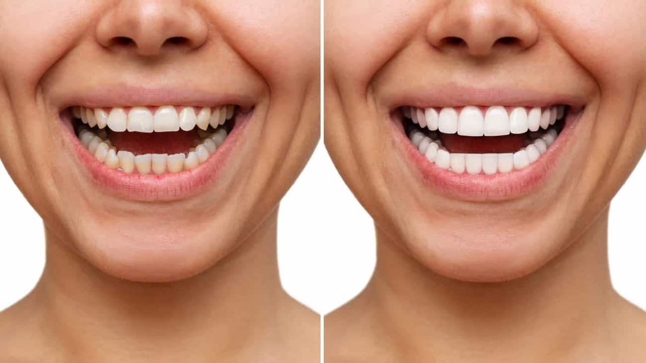 Contact Aspire White for teeth whitening services – Get in touch with Huddersfield today