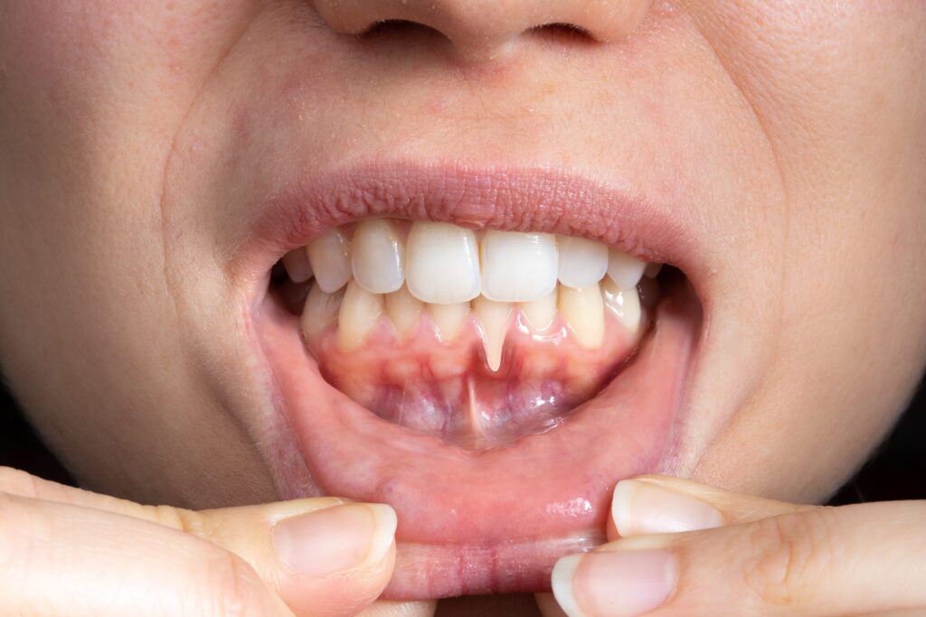 Preparing for teeth whitening with receding gums Huddersfield