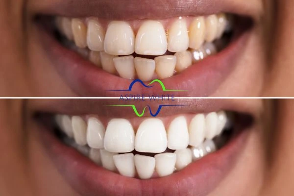 Aspire White customer before and after Huddersfield results.
