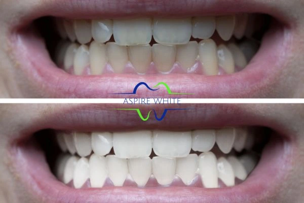 1 hour laser teeth whitening before and after results Huddersfield