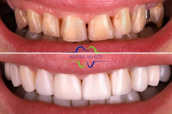 Yellow teeth results - 1 hour whitening before and after results Huddersfield