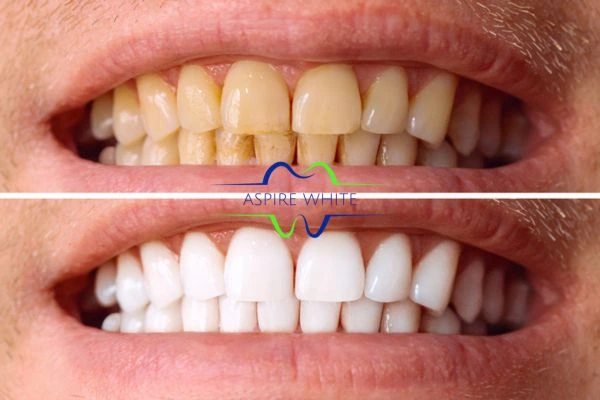 Get noticeable whiter smile in just one hour! Book your teeth whitening treatment Huddersfield today!