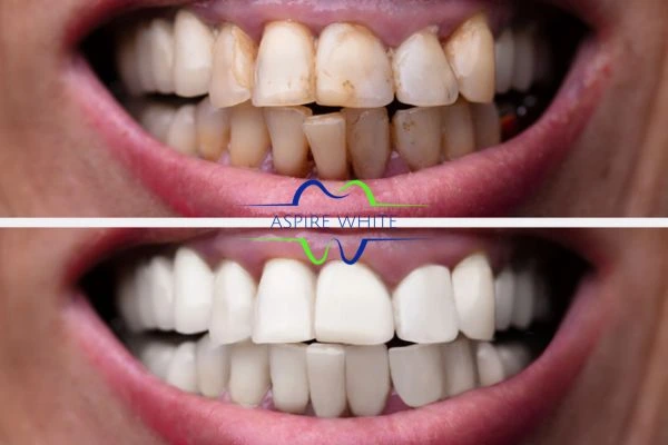 Before and after results of laser teeth whitening Huddersfield Book in online today!