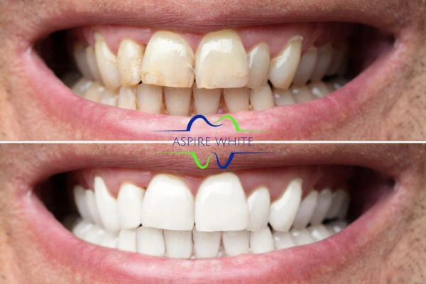 Achieve a radiant smile with professional laser teeth whitening Huddersfield
